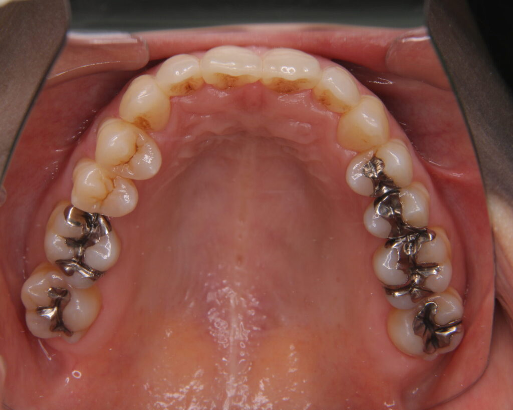 出っ歯・口ゴボ治療例３（治療後上顎咬合面）