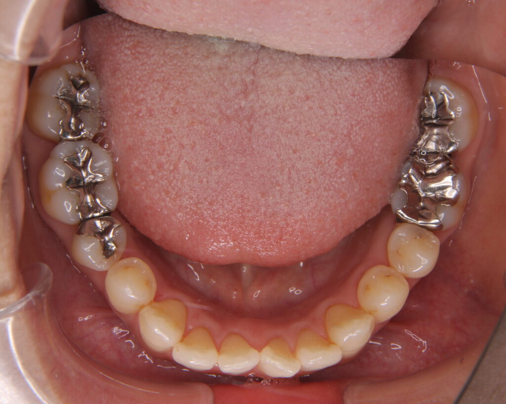 出っ歯・口ゴボ治療例３（治療後下顎咬合面）