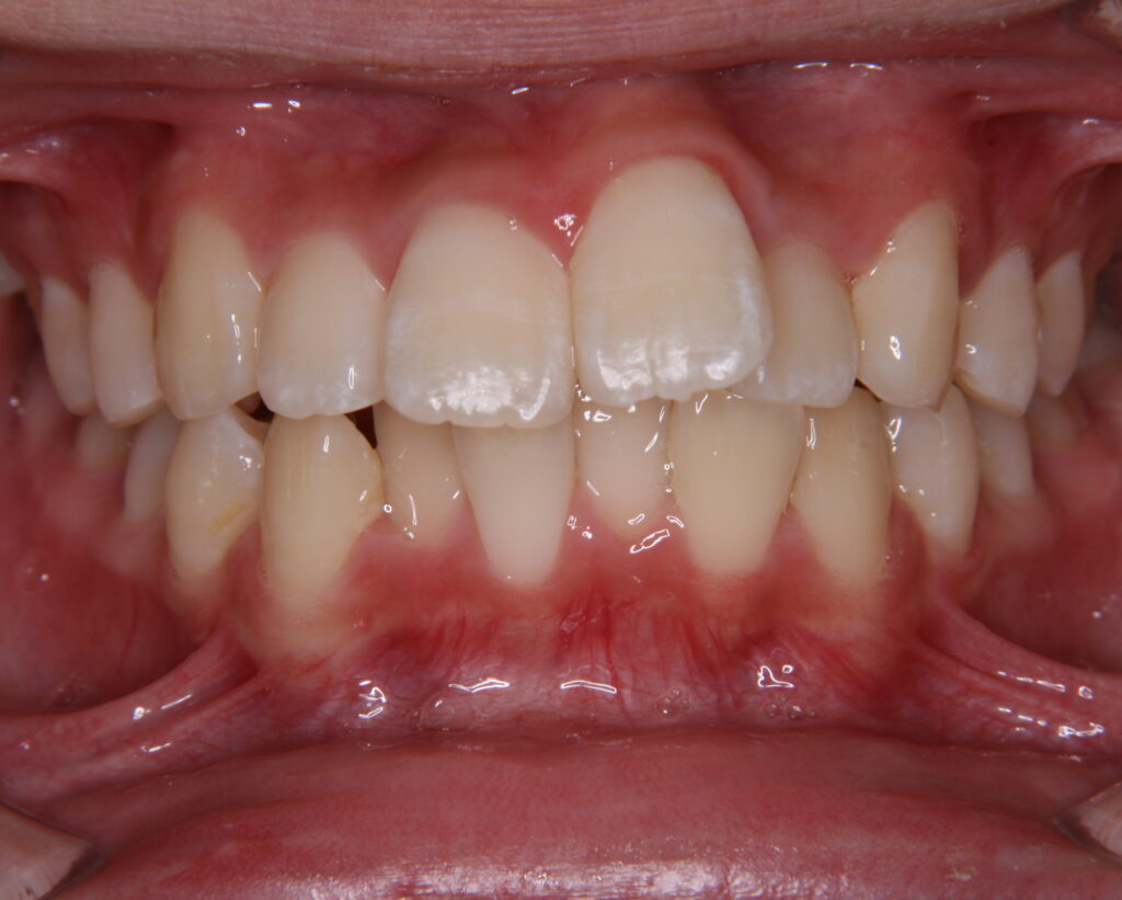 出っ歯・口ゴボ治療例４（治療前正面）