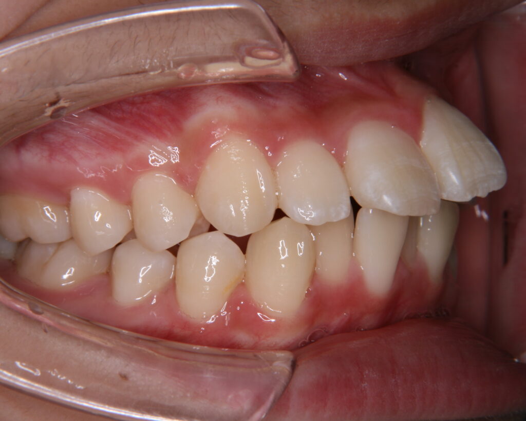 出っ歯・口ゴボ治療例４（治療前側方）