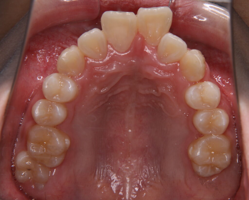 出っ歯・口ゴボ治療例４（治療前上顎咬合面）