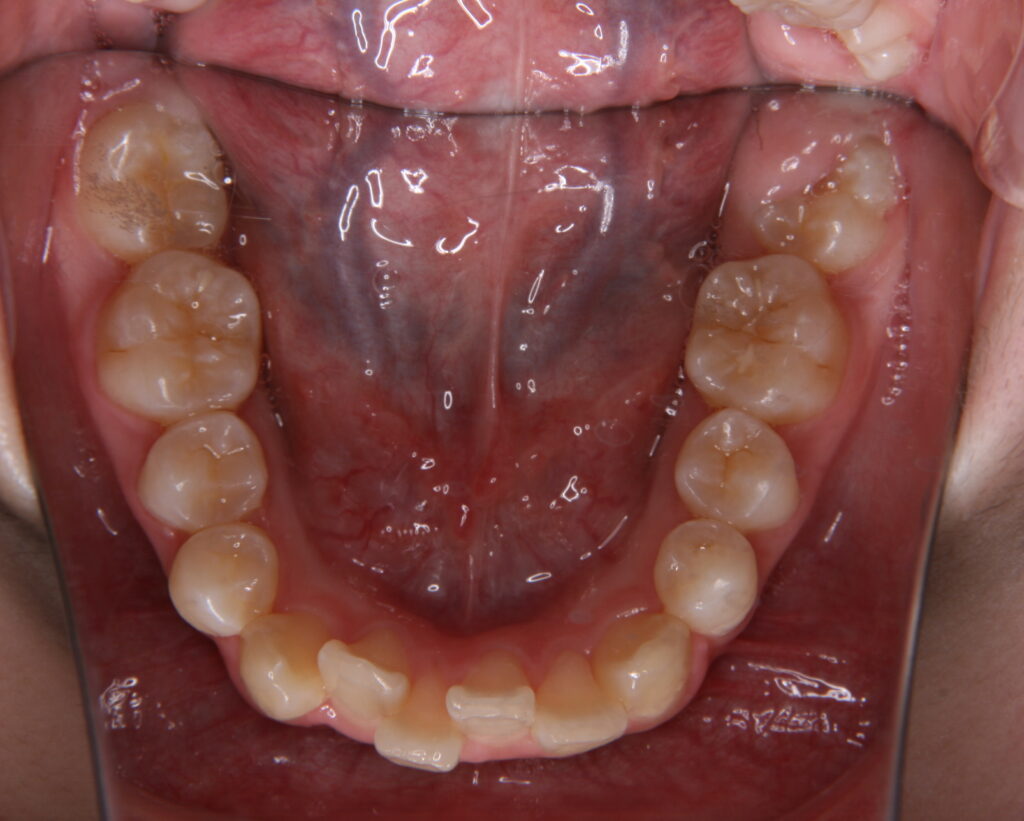 出っ歯・口ゴボ治療例４（治療前下顎咬合面）