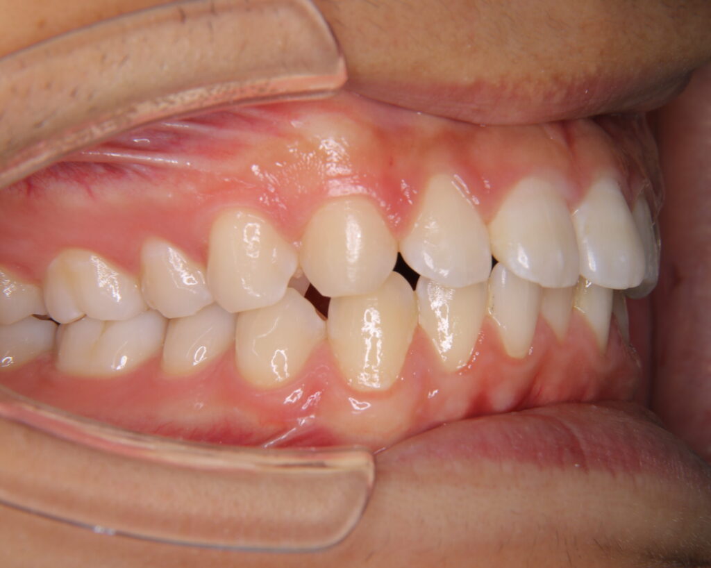 すきっ歯治療例２（治療後側方）