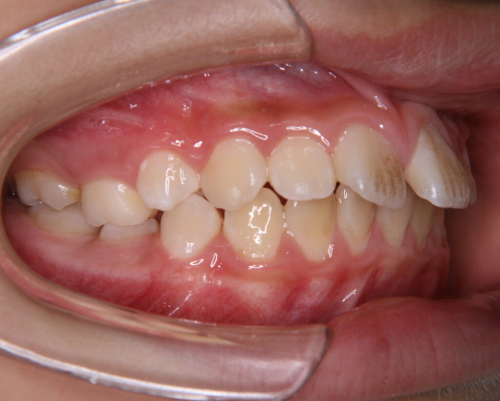 出っ歯・口ゴボ治療例２（治療前右側方）