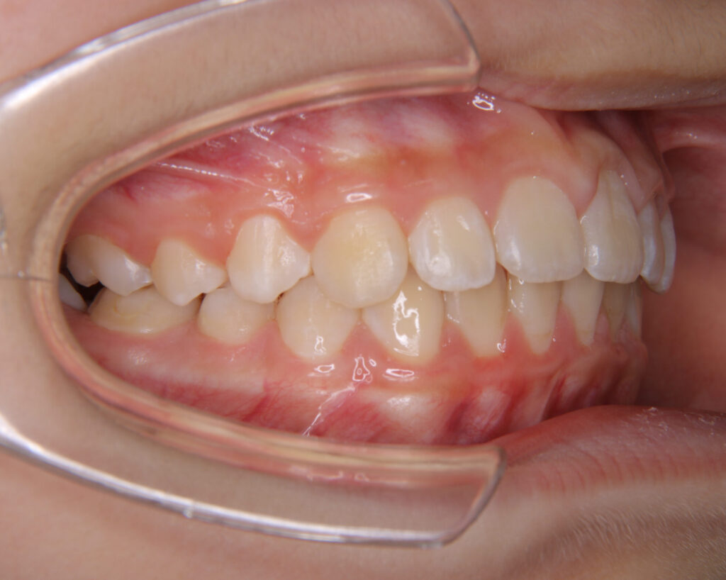 出っ歯・口ゴボ治療例２（治療後側方）
