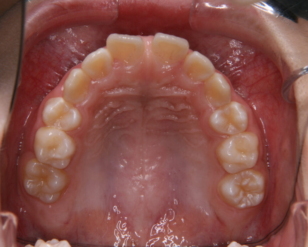出っ歯・口ゴボ治療例２（治療前上顎咬合面）