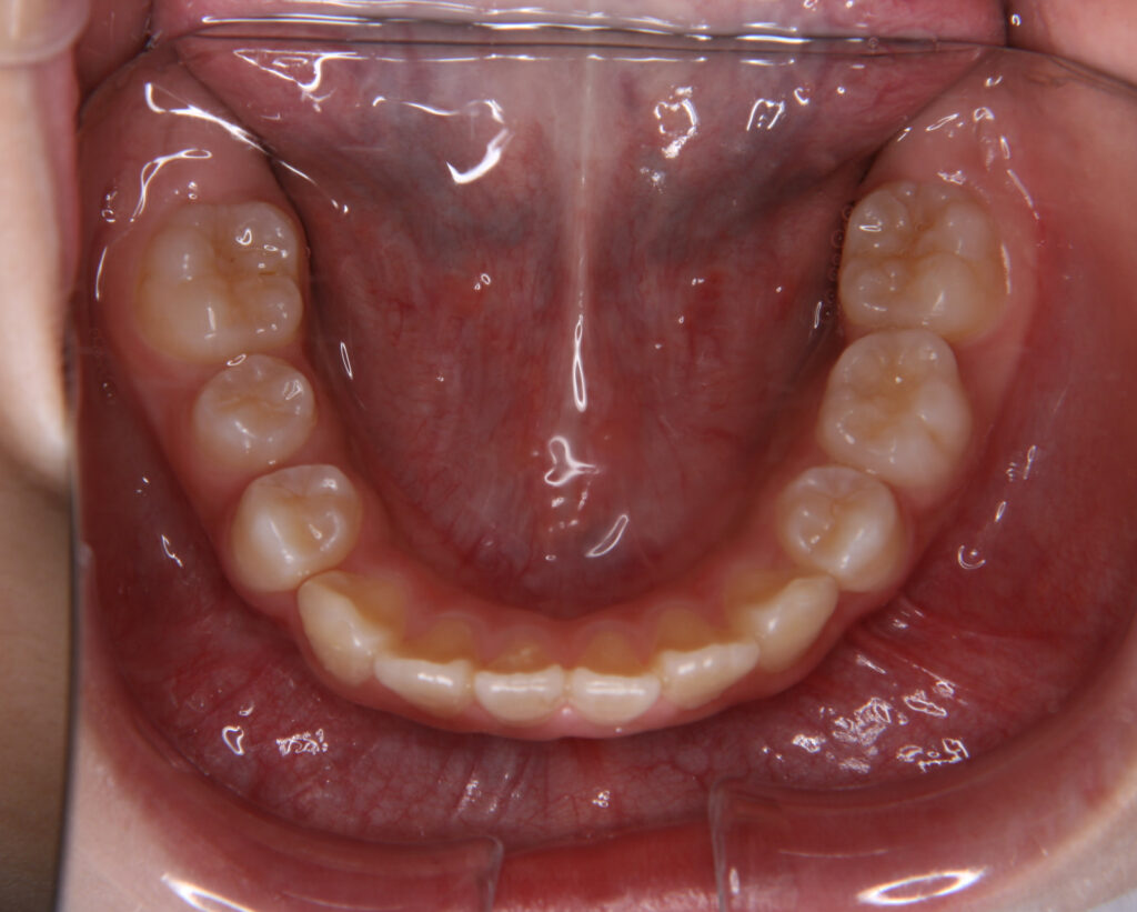出っ歯・口ゴボ治療例２（治療前下顎咬合面）