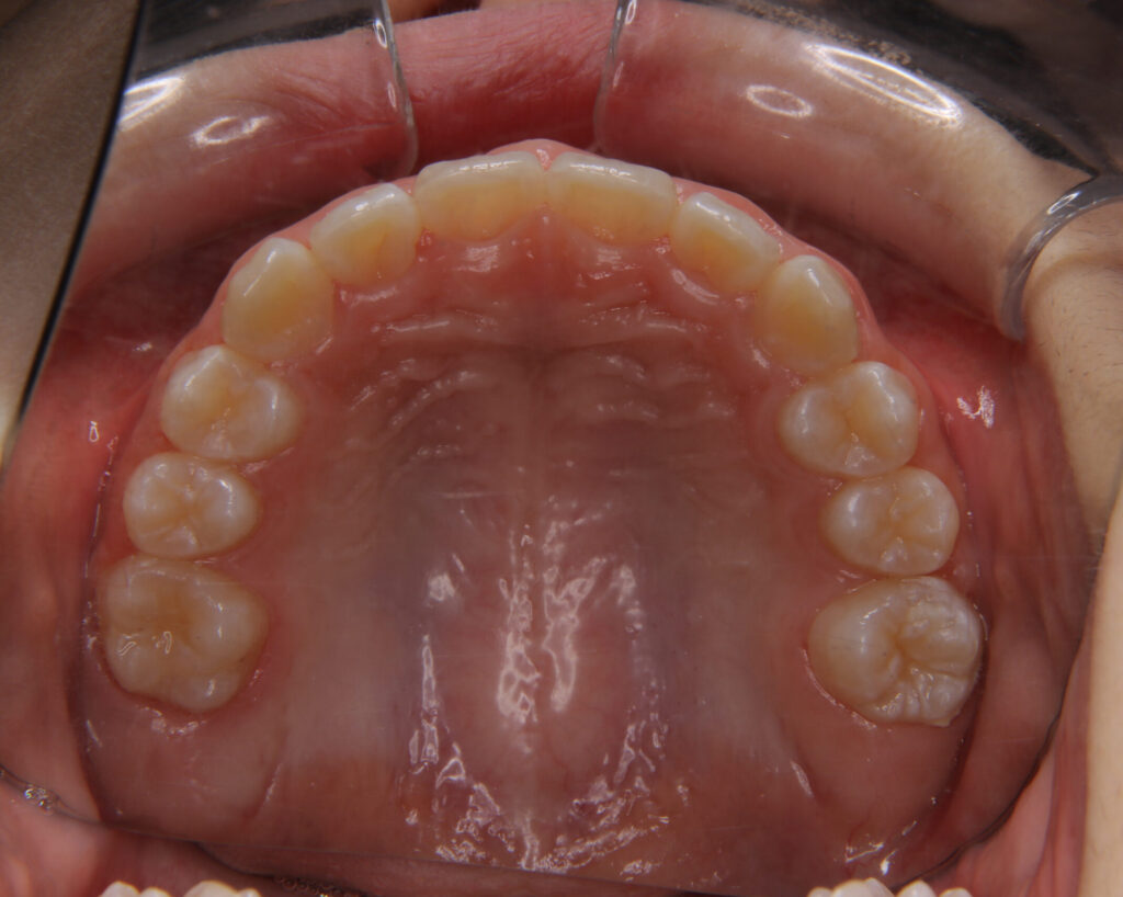 出っ歯・口ゴボ治療例２（治療後上顎咬合面）