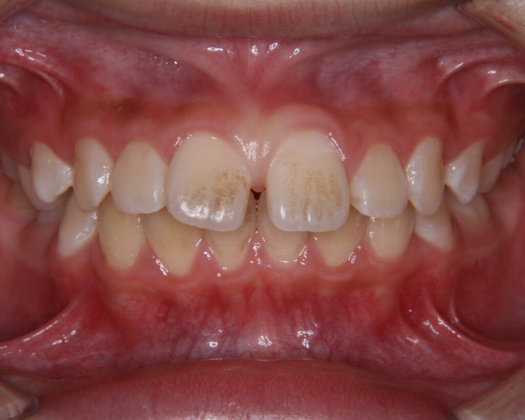 出っ歯・口ゴボ治療例２（治療前正面）