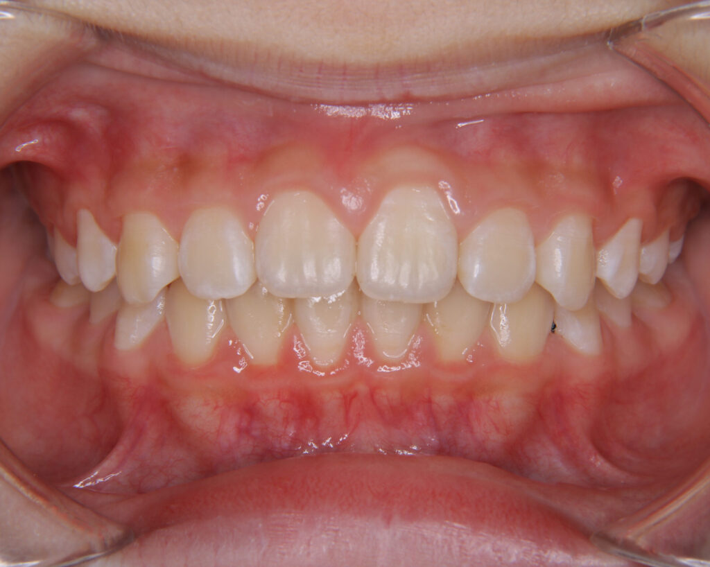 出っ歯・口ゴボ治療例２（治療後正面）