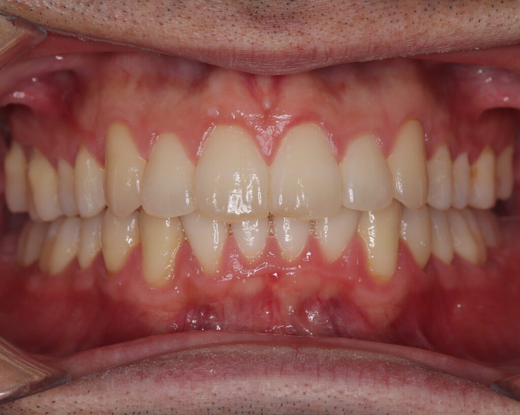 出っ歯・口ゴボ治療例６（治療後正面）