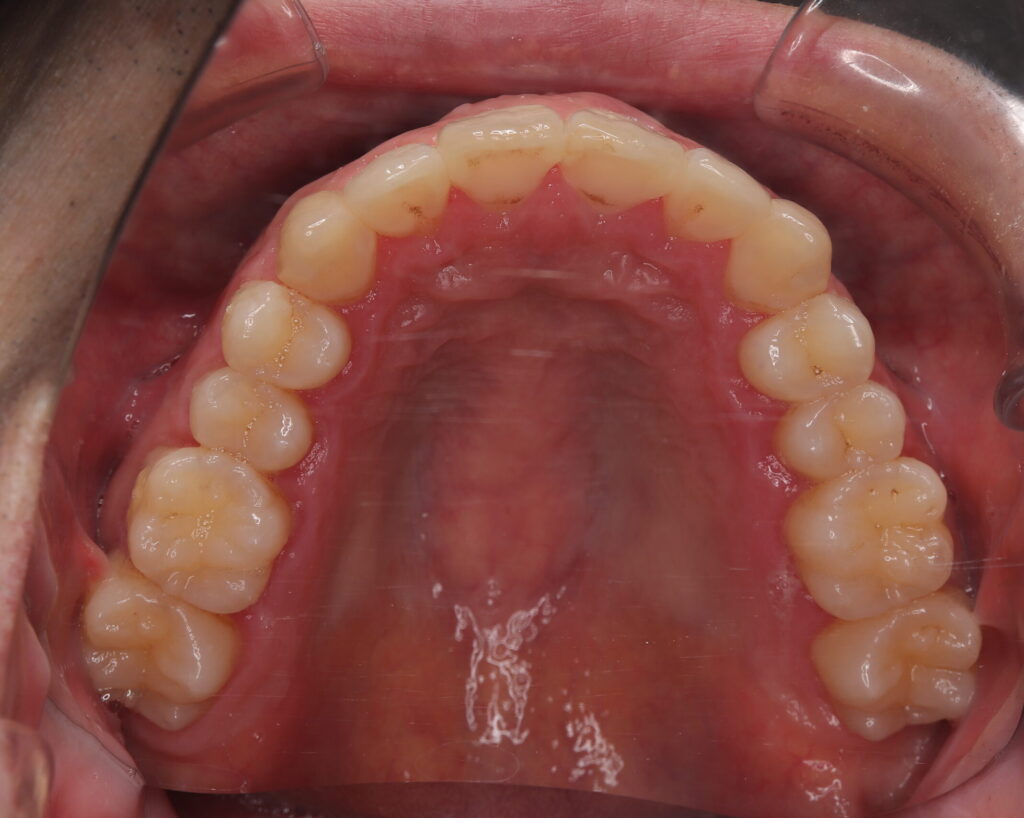 出っ歯・口ゴボ治療例６（治療後上顎咬合面）
