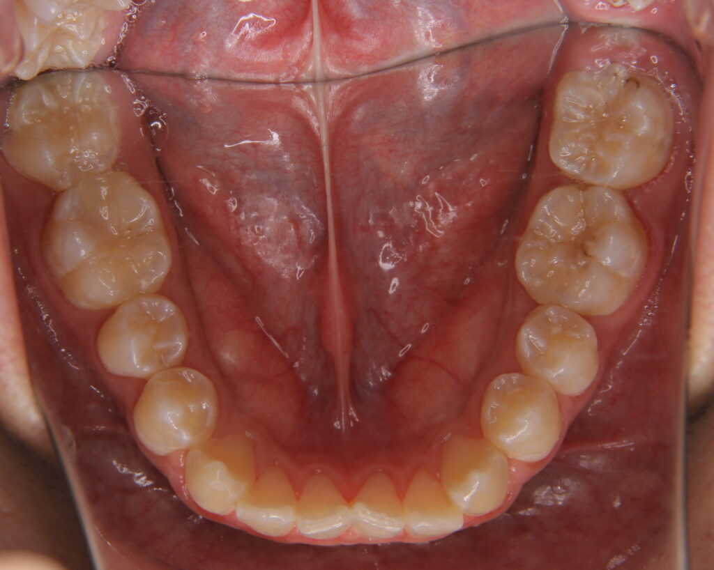 叢生・八重歯の治療例２（治療前下顎咬合面）