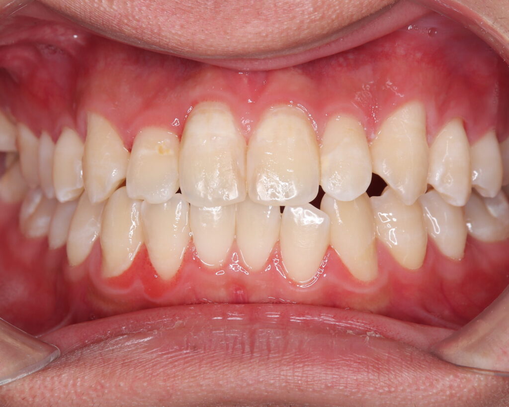 叢生・八重歯の治療例２（治療後正面）