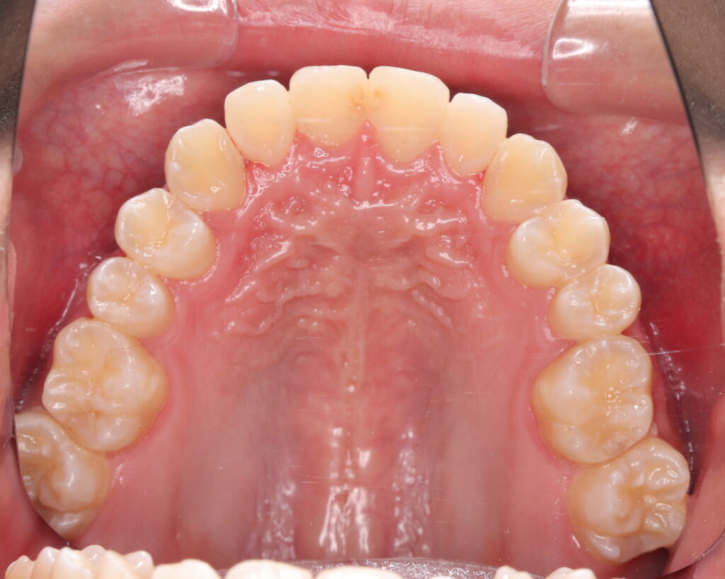 叢生・八重歯の治療例２（治療後上顎咬合面）