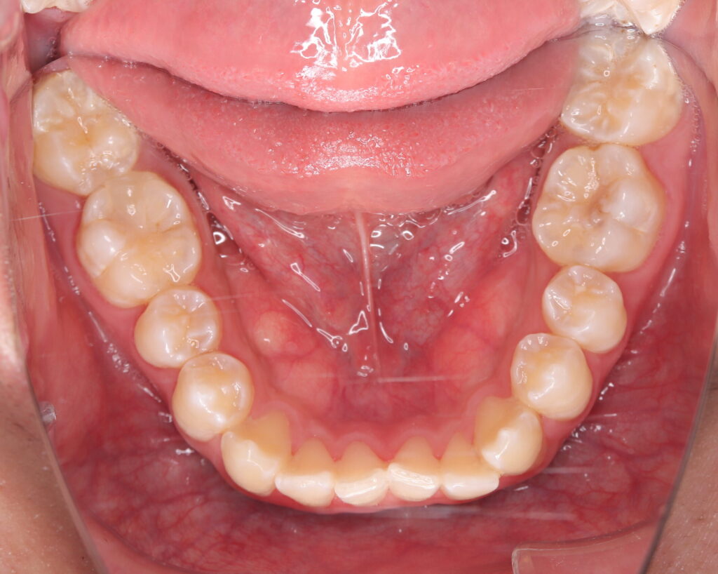 叢生・八重歯の治療例２（治療後下顎咬合面）