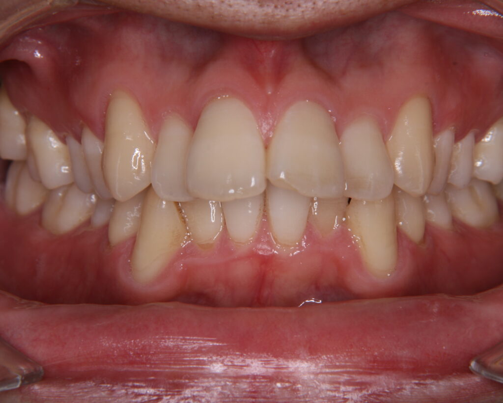 出っ歯・口ゴボ治療例６（治療前正面）