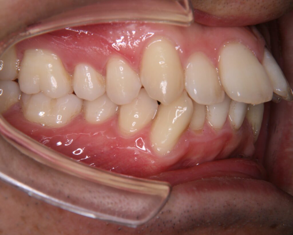 出っ歯・口ゴボ治療例６（治療前側方）