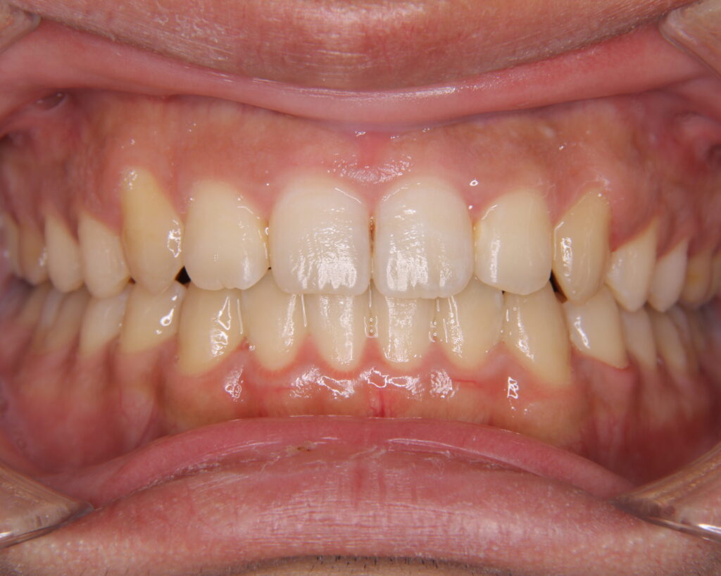 叢生・八重歯の治療例５（治療後前方）
