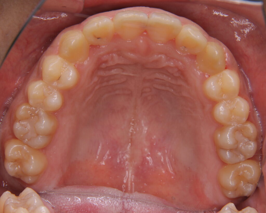 叢生・八重歯の治療例５（治療後咬合面上顎）