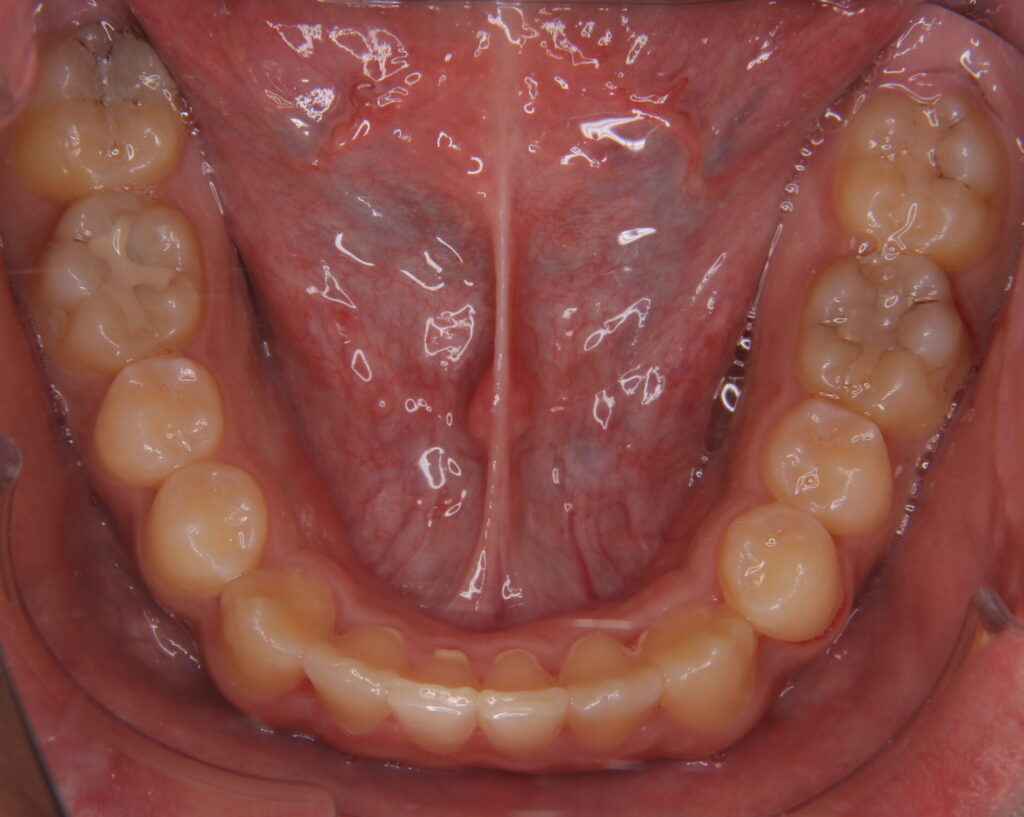 叢生・八重歯の治療例５（治療後咬合面下顎）