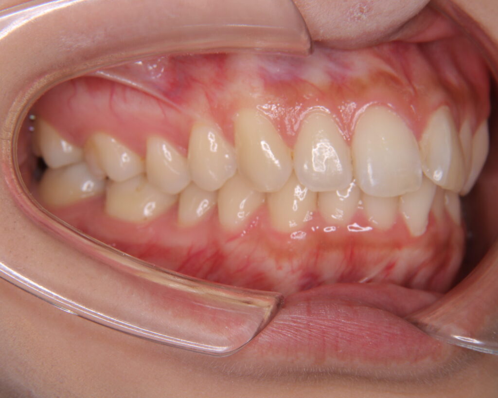 叢生・八重歯の治療例４（治療前側方）