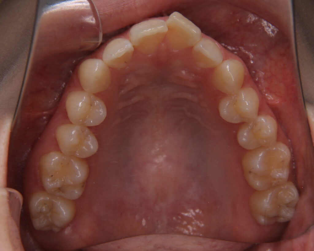 叢生・八重歯の治療例４（治療前上顎）