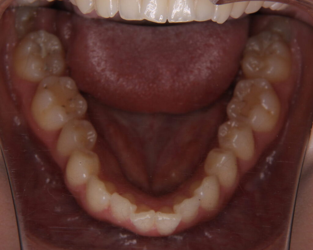 叢生・八重歯の治療例４（治療前下顎）