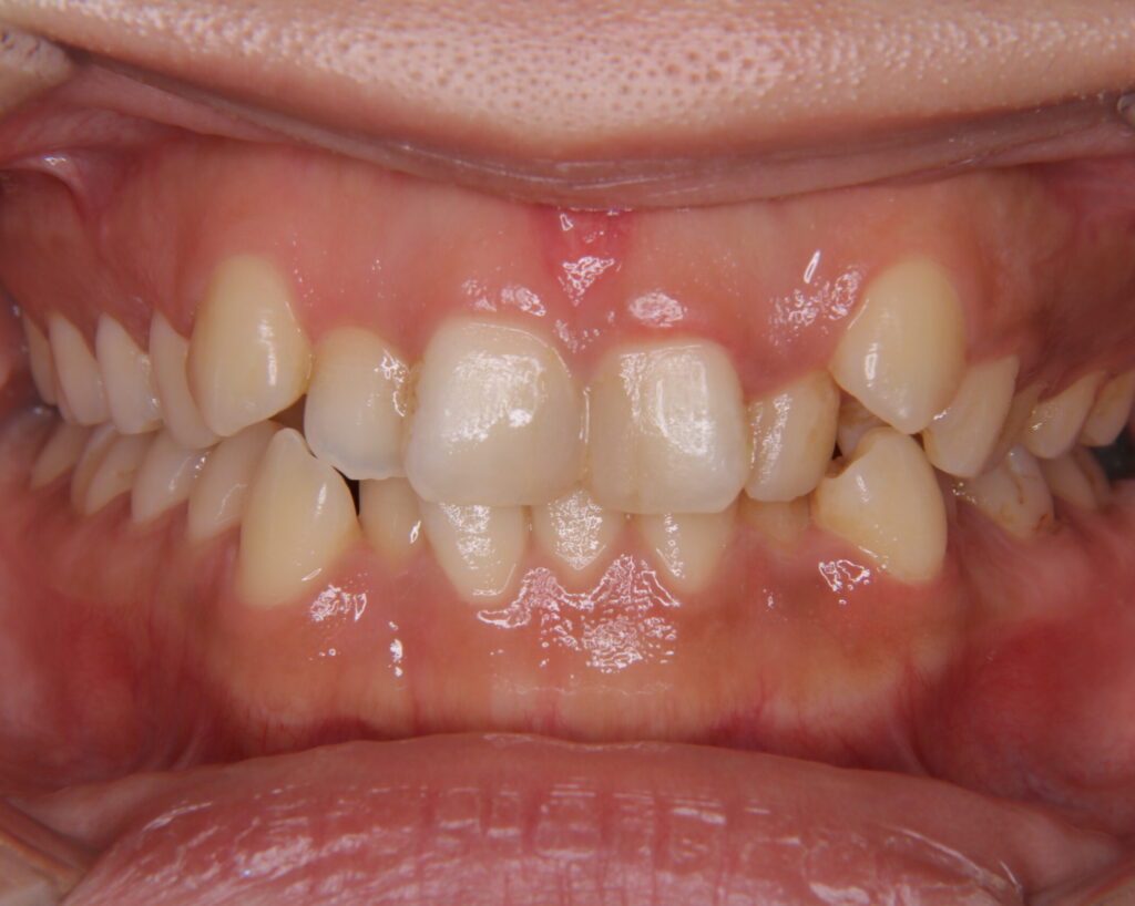 叢生・八重歯の治療例６（治療前正面）
