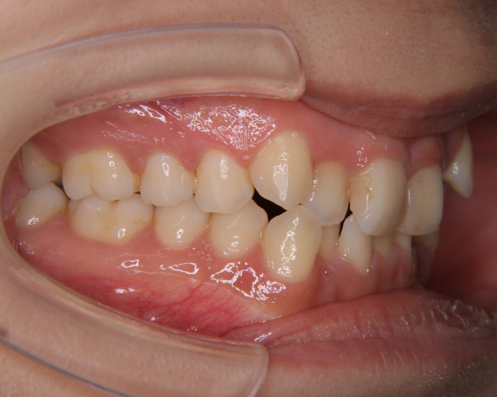 叢生・八重歯の治療例７（治療前側方）