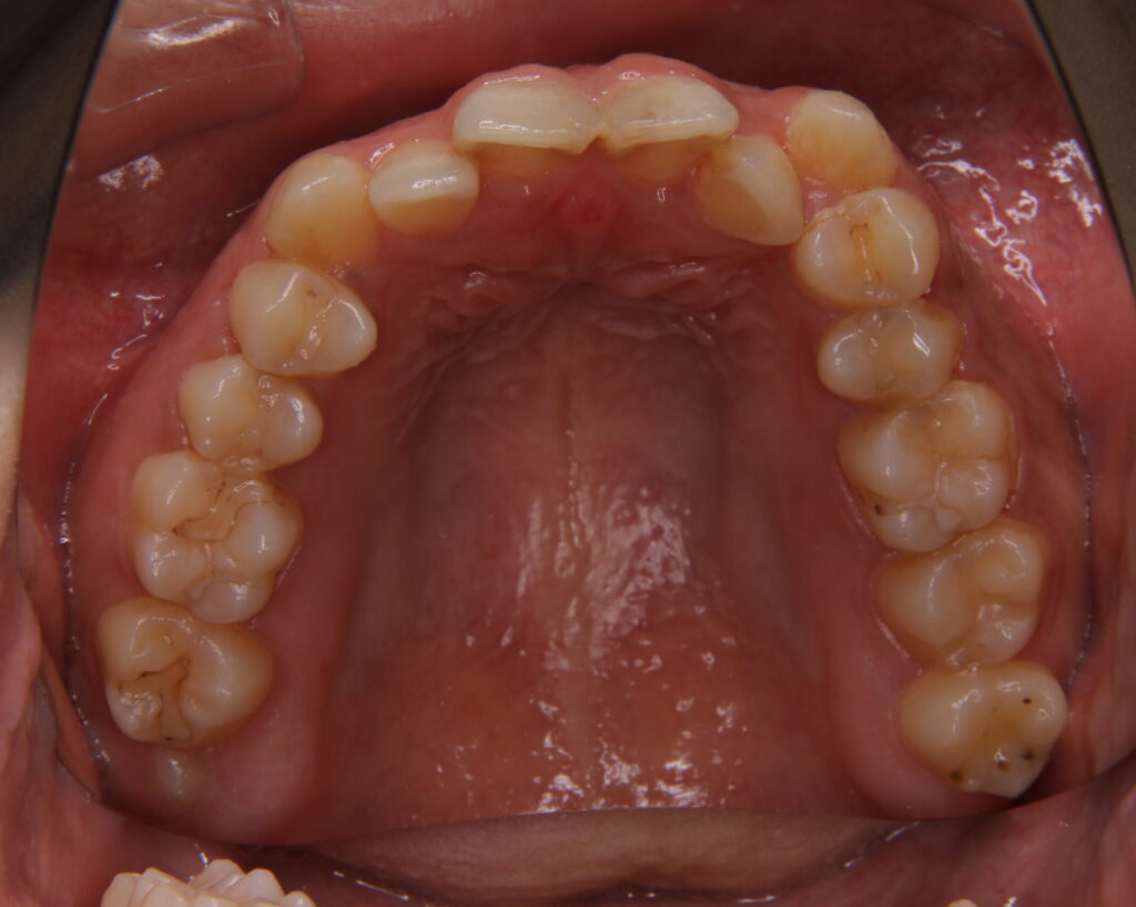 叢生・八重歯の治療例６（治療前上顎咬合面）