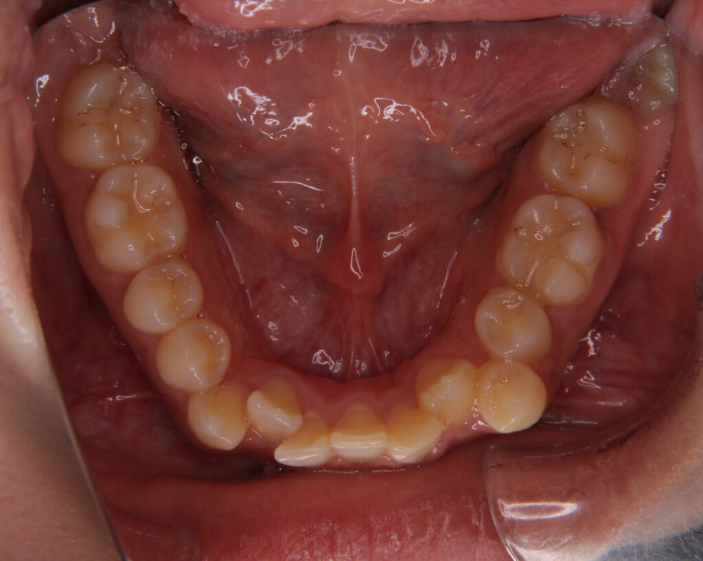 叢生・八重歯の治療例６（治療前下顎咬合面）