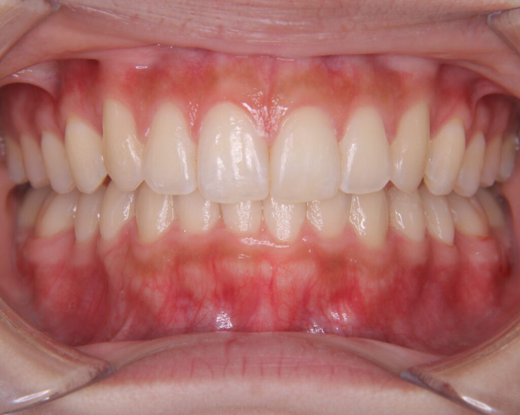 叢生・八重歯の治療例４（治療後前方）