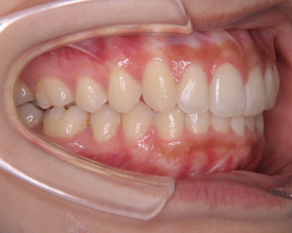 叢生・八重歯の治療例４（治療後側方）