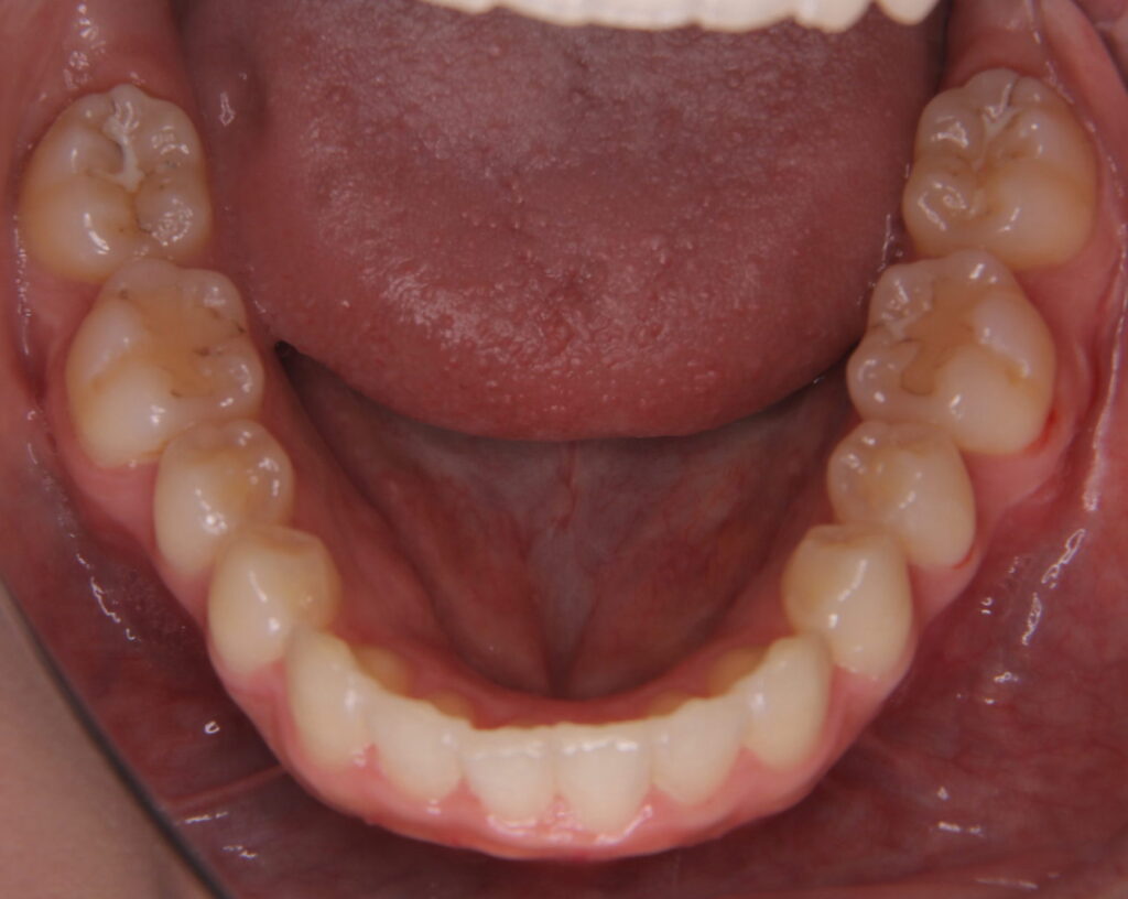 叢生・八重歯の治療例４（治療後下顎）