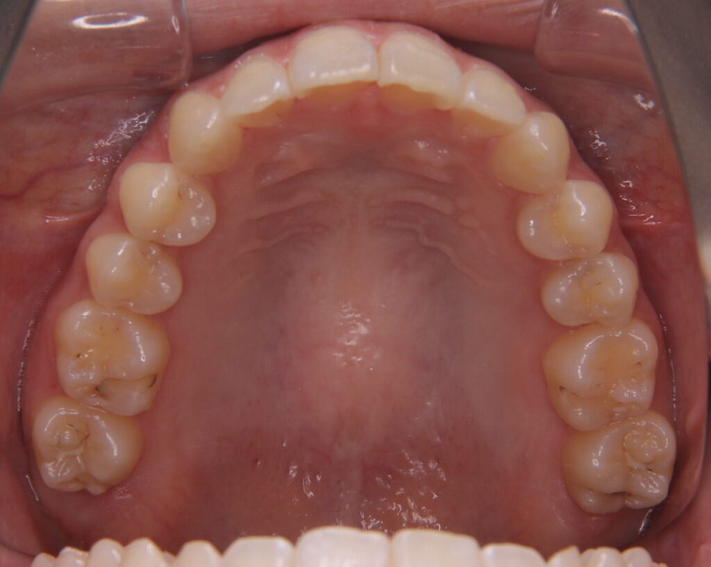 叢生・八重歯の治療例４（治療後上顎）