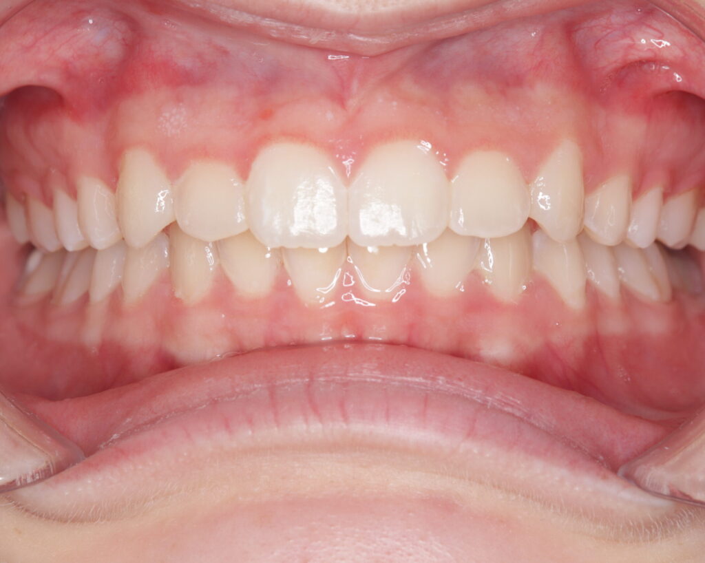 叢生・八重歯の治療例７（治療後正面）