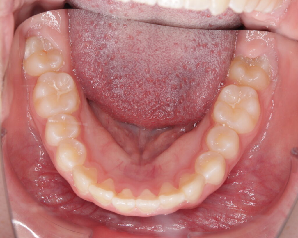 叢生・八重歯の治療例７（治療後下顎咬合面）