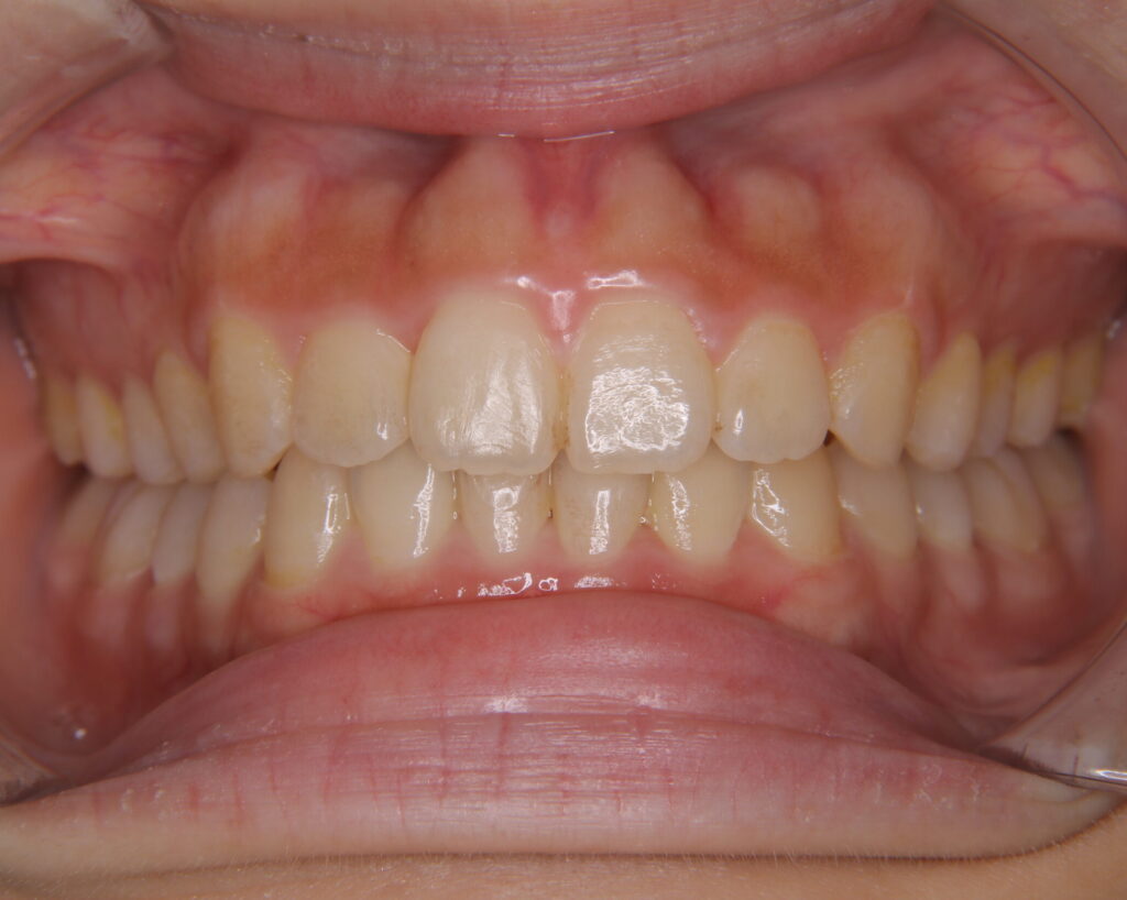出っ歯・口ゴボ治療例７（治療後正面）
