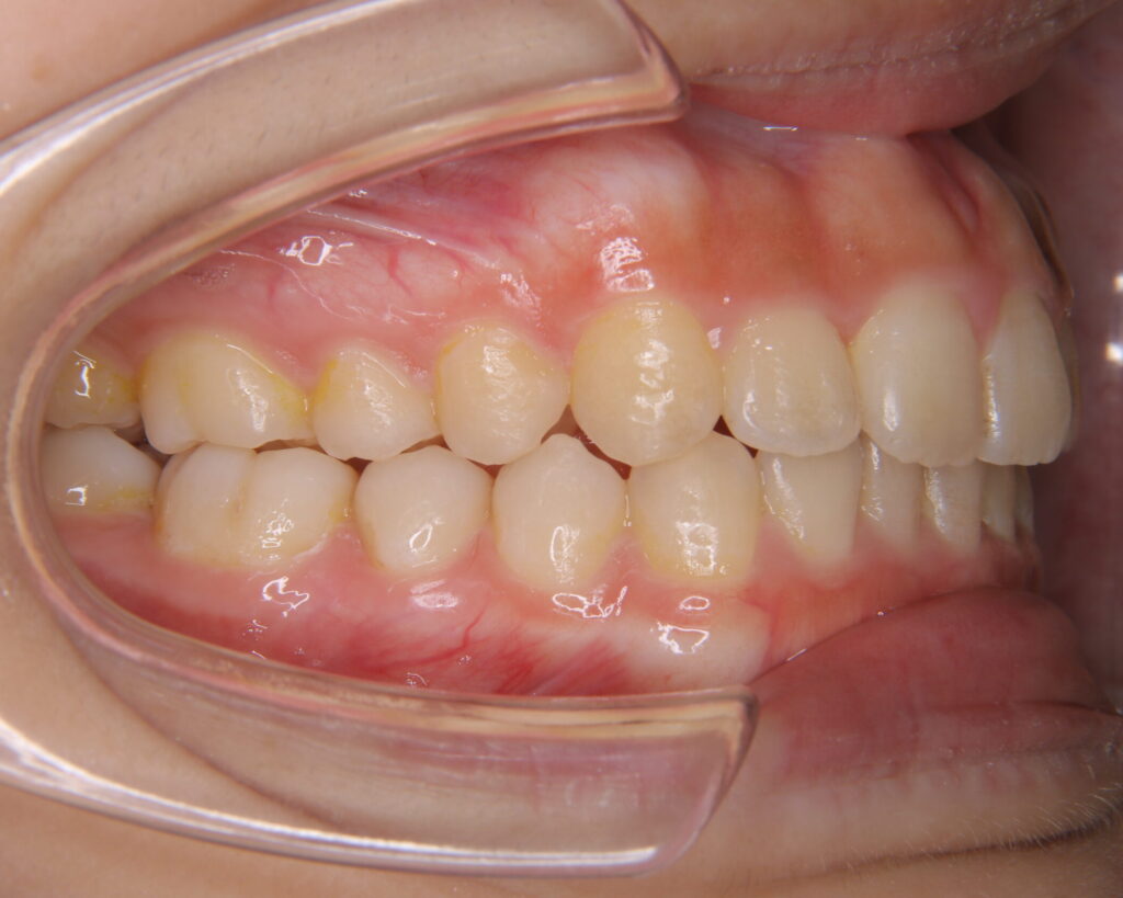 出っ歯・口ゴボ治療例７（治療後側方）