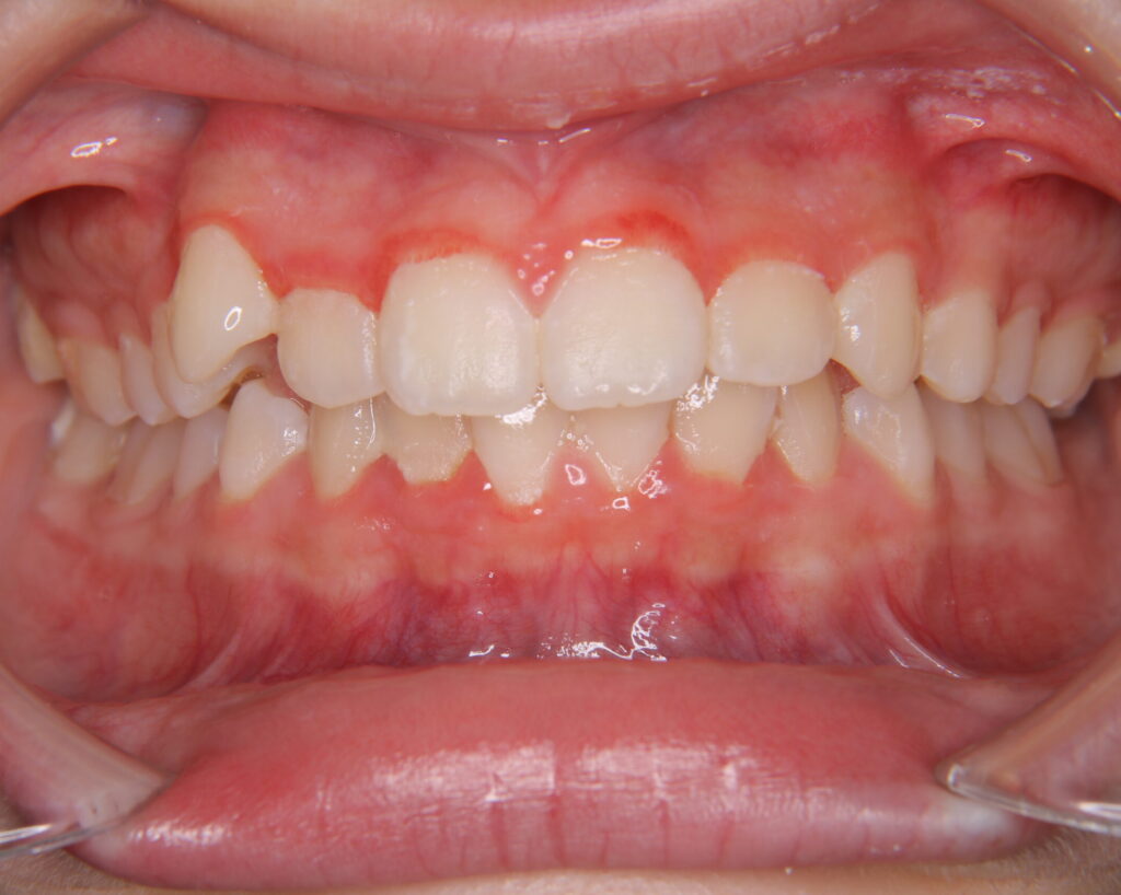 叢生・八重歯の治療例７（治療前正面）
