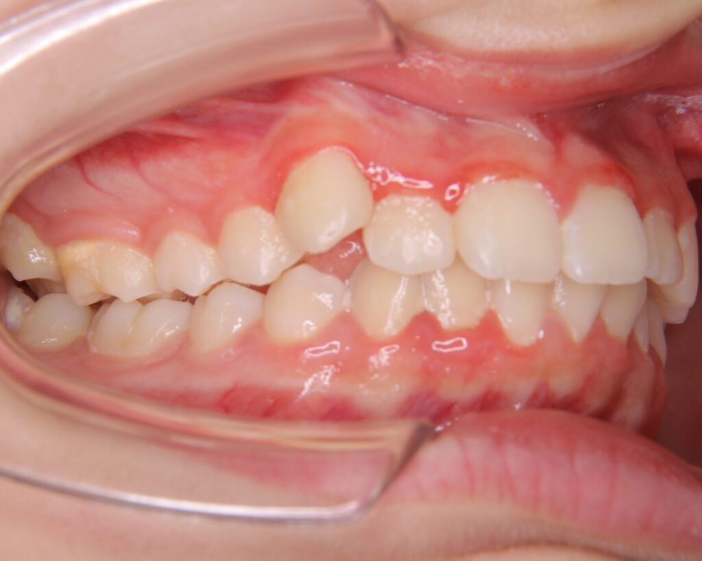 叢生・八重歯の治療例７（治療前側方）