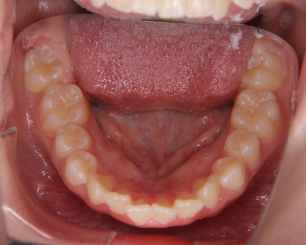 叢生・八重歯の治療例７（治療前下顎咬合面）