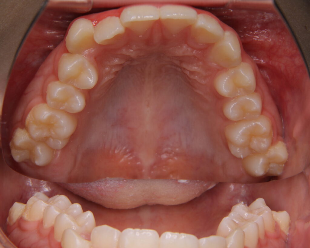 叢生・八重歯の治療例７（治療前上顎咬合面）
