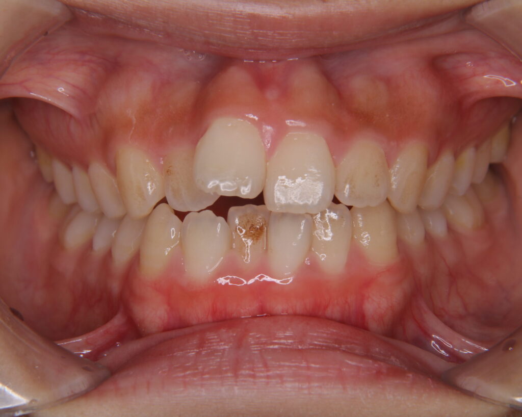 出っ歯・口ゴボ治療例７（治療前正面）