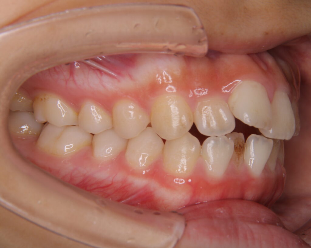 出っ歯・口ゴボ治療例７（治療前側方）