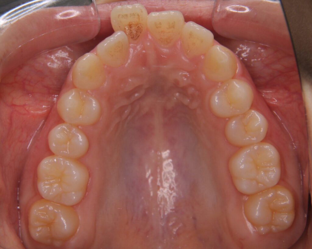 出っ歯・口ゴボ治療例７（治療前上顎咬合面）