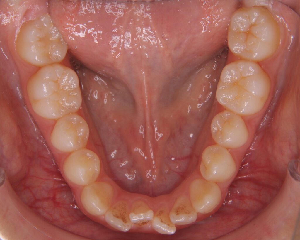 出っ歯・口ゴボ治療例７（治療前下顎咬合面）