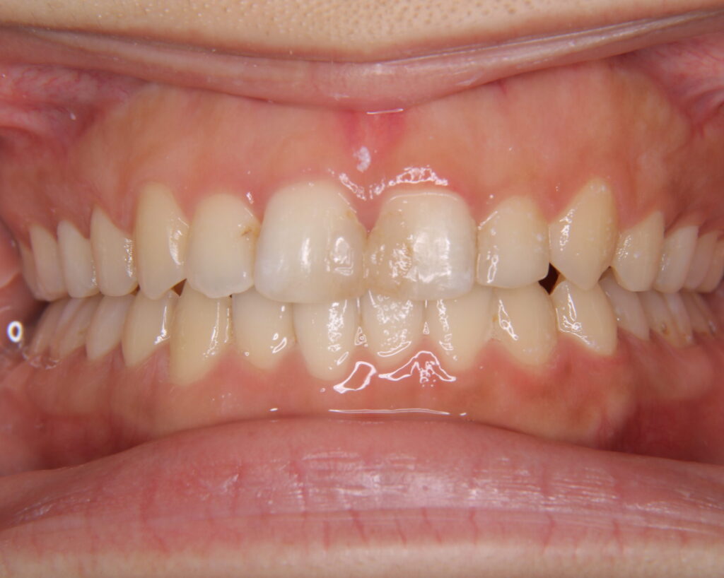 叢生・八重歯の治療例６（治療後正面）