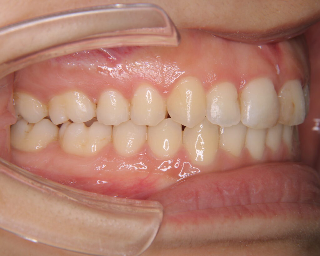 叢生・八重歯の治療例６（治療後側方）